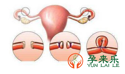 输卵管堵塞病因有哪些？输卵管堵塞可以直接试管吗？