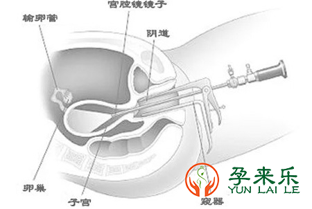 试管婴儿为什么要做宫腔镜？哪些女性做试管婴儿就要做宫腔镜检查？