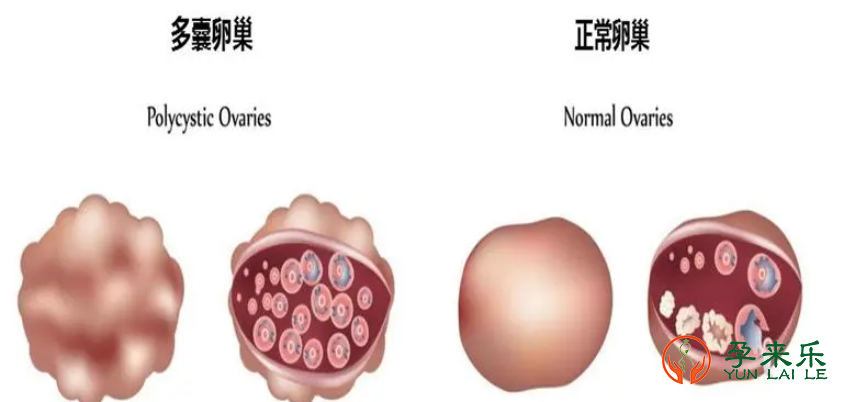 什么是多囊？多囊可以做三代试管吗？