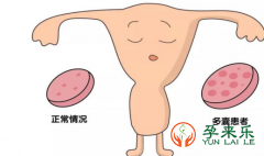 什么是多囊?要孩子的多囊卵巢综合症女性想要生育的方法有哪些？